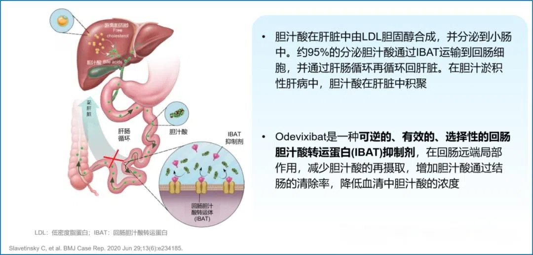 奥维昔巴特：改写胆汁淤积性疾病治疗格局的革命性药物(图1)